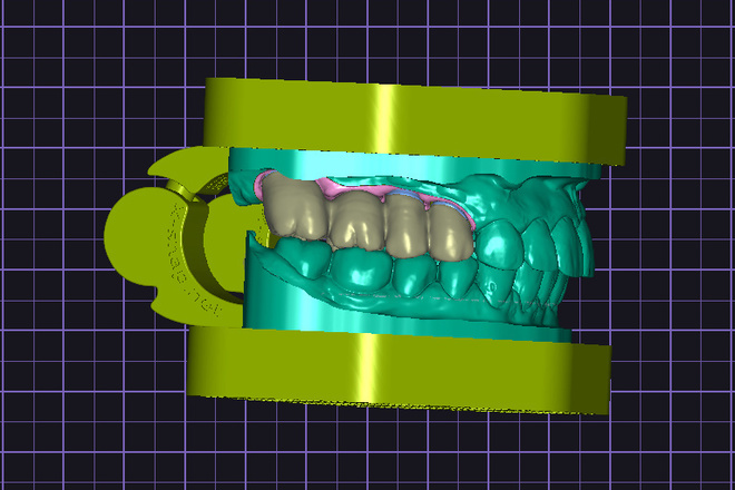 Implant-Supported Crowns & Bridges - CadCam Masters