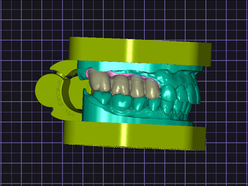 Dental Cad Service: Implant-Supported Crowns & Bridges