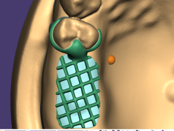 Dental Cad Service: Metal framework for partial denture