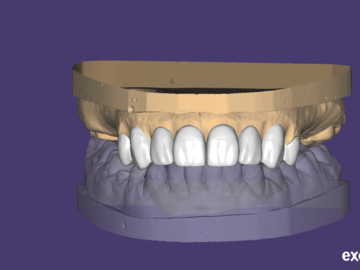Dental Cad Service: VENEERS