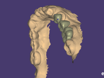 Dental Cad Service: provisional, temporary crowns/ bridges