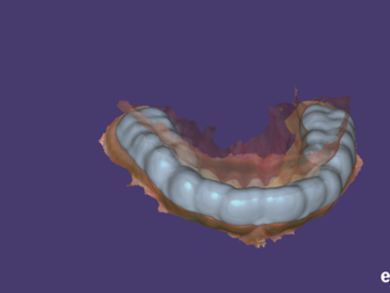 Dental Cad Service: bite splint