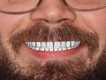 Dental Cad Service: Digital Smile Design