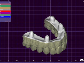 Dental Cad Service: Immediate AOX prosthesis + separated bar 