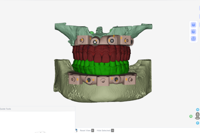Stackable Guide In One Time High-end stackable guides + AOX prosthesis/ converted denture - CadCam ...