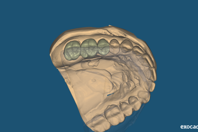 Crown and Bridge - CadCam Masters