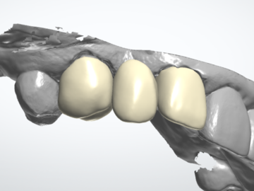 Dental Cad-Service: crown & bridge on 3shape