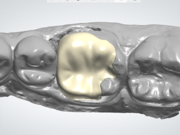 Dental Cad-Service: Onlay & inlay on 3shape