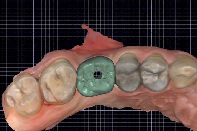 Implant Crown and Bridge - CadCam Masters