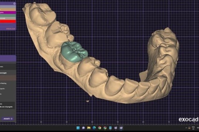Onlays and Inlays - CadCam Masters