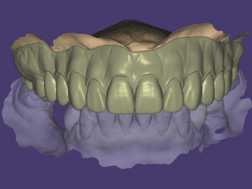 Dental Cad Service: Preop dentures for immediate AOX/full digital dentures