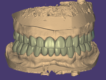 Dental Cad-Service: Natural full/ reduced crowns and bridges