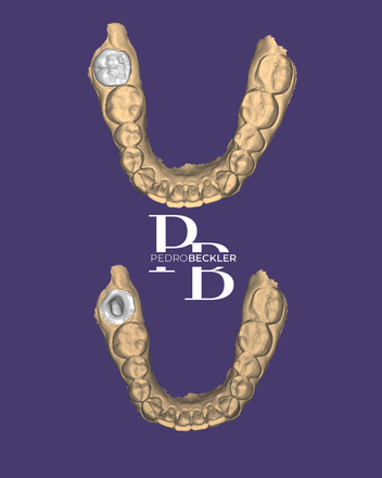 Endo crown - CadCam Masters