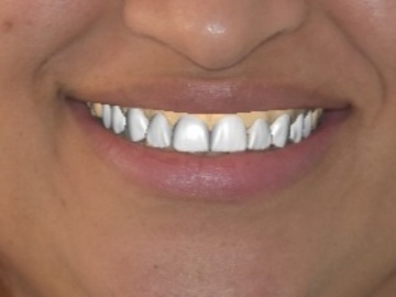 Service de Cad Dentaire: Refinement and DSD modification