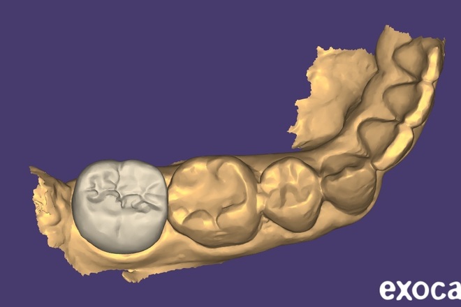 [Designed By Clinician] C&B CAD Design | Occlusion-Focused - CadCam Masters