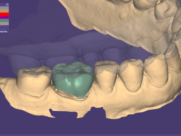 Dental Cad Service: Single Crown