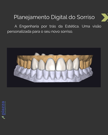 Mock-Up / Smile Design - CadCam Masters