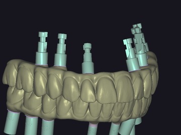 Servicio de Cad Dental: CARGAS INMEDIATAS