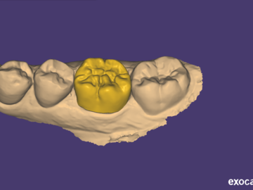 Serviço de Cad Dental: Single Crown