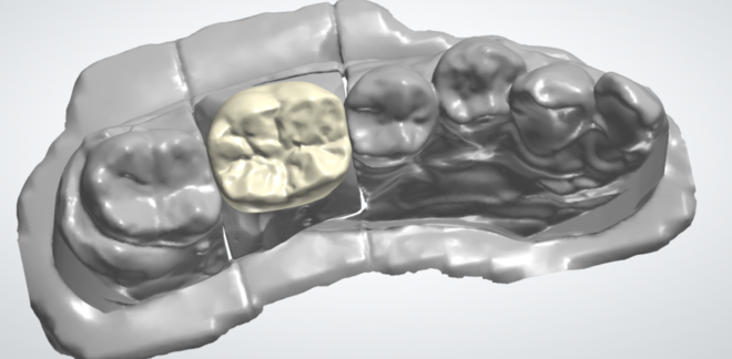 Crown\Bridge - CadCam Masters