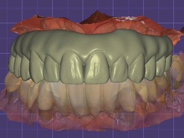 Serviço de Cad Dental: All on X