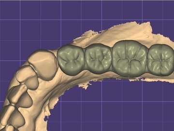Dental Cad-Service: Bridge