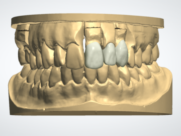 Dental Cad Service: Crown and Bridge design 3Shape 