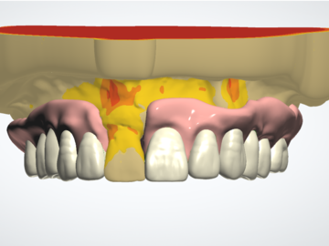 Dental Cad Service: Partial denture design