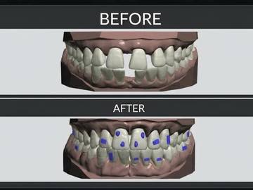 Dental Cad-Service: Clear Aligner Treatment Planning & Setup | 3Shape Ortho Analyzer