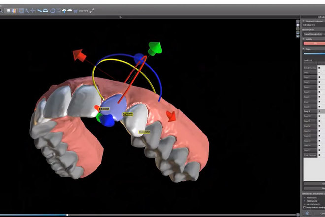 Planeamento de Alinhadores Ortodonticos - CadCam Masters