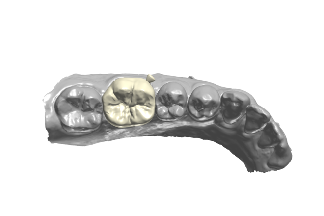 Crown - CadCam Masters