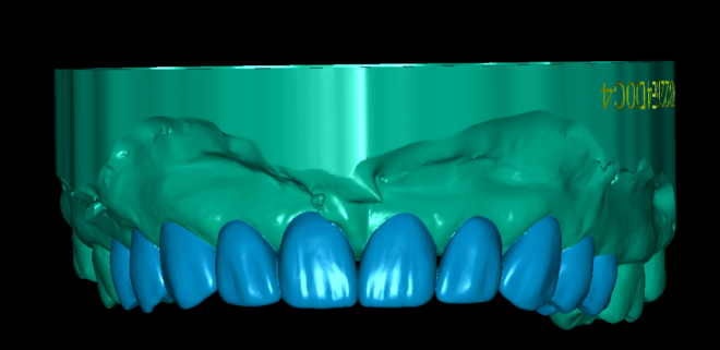 EXOCAD WAXUP (MOCK UP) - CadCam Masters