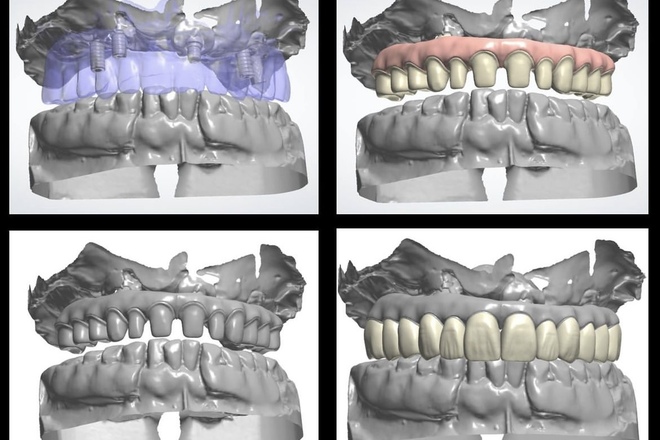 Crown,Bridge,wironit. - CadCam Masters