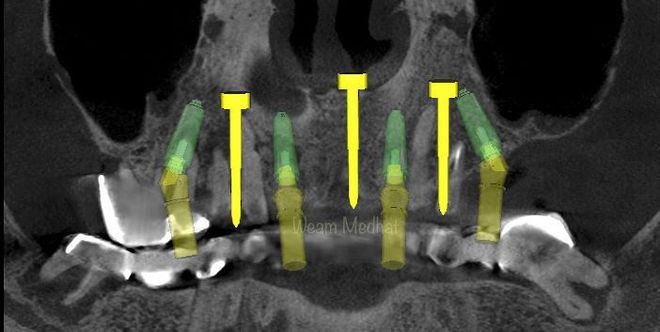 Implant Treatment Planning & Surgical Guide Design - CadCam Masters