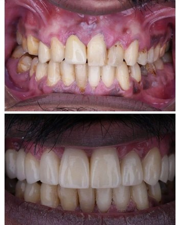 Veneers - CadCam Masters