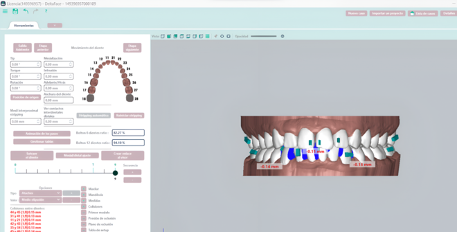Custom orthodontic Aligner design - CadCam Masters