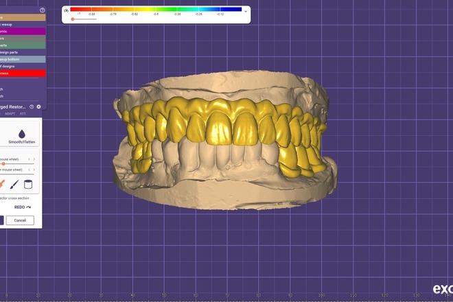 Crown & Bridge Design - CadCam Masters