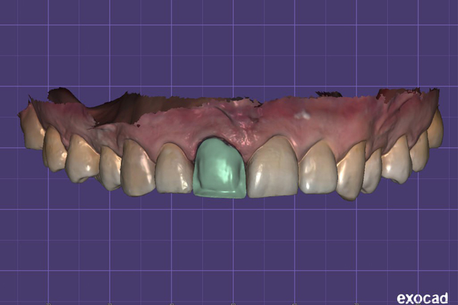 Anatomical veneers. Qualitatively and Quickly. - CadCam Masters
