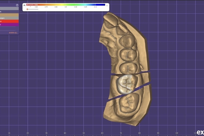 dental design CAD - CadCam Masters