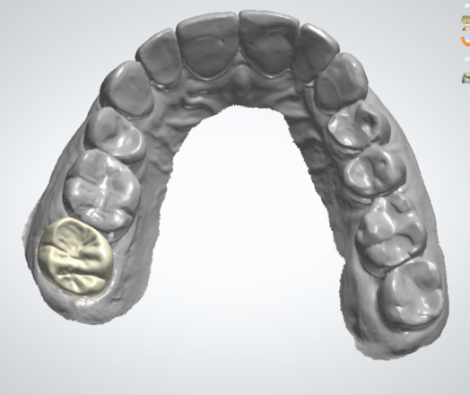 crowns - CadCam Masters