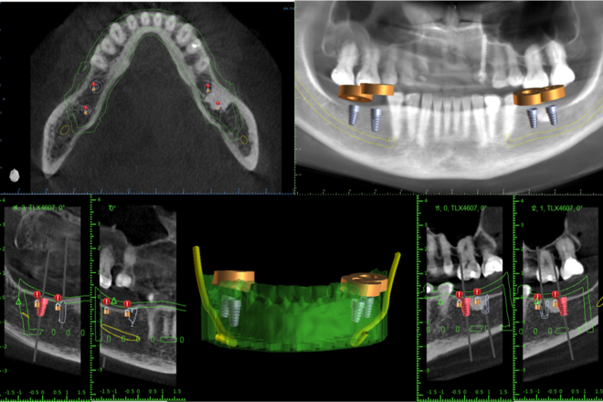 Implant Planning + Surgical Guide - CadCam Masters