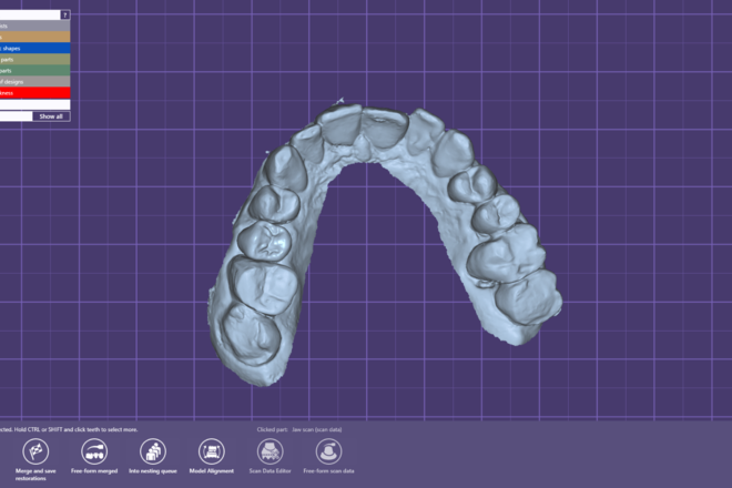 Inlay /onlay _ anatomic crown _ full arch over implant - CadCam Masters