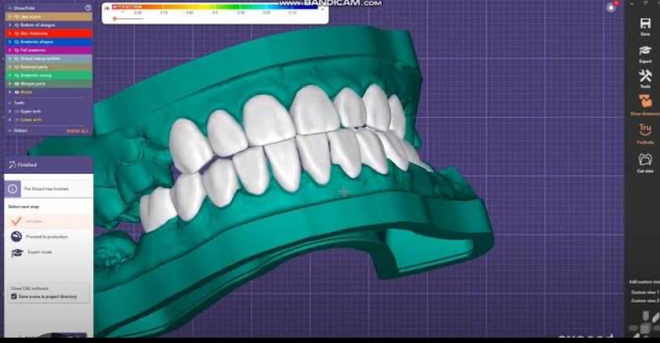 Veneers - CadCam Masters