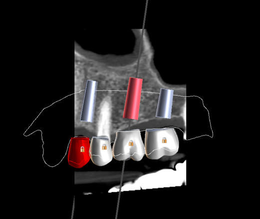 implant planning & surgical guide design - CadCam Masters