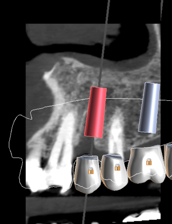 implant planning & surgical guide design - CadCam Masters