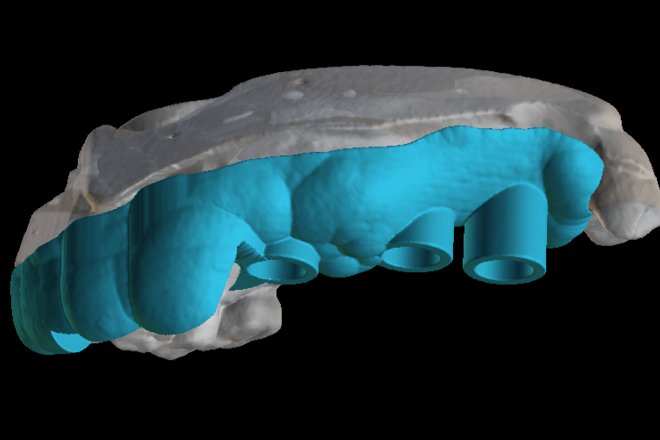 implant planning & surgical guide design - CadCam Masters