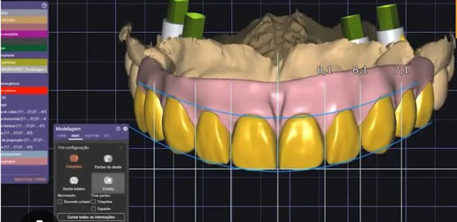 Crown & bridge - CadCam Masters