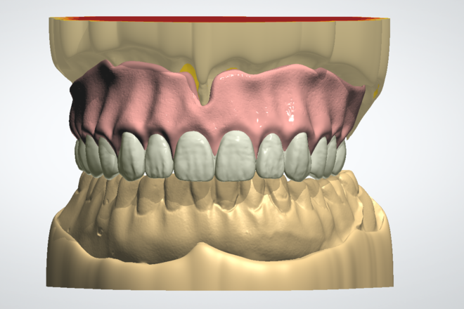 Full/Partial Dentures - CadCam Masters