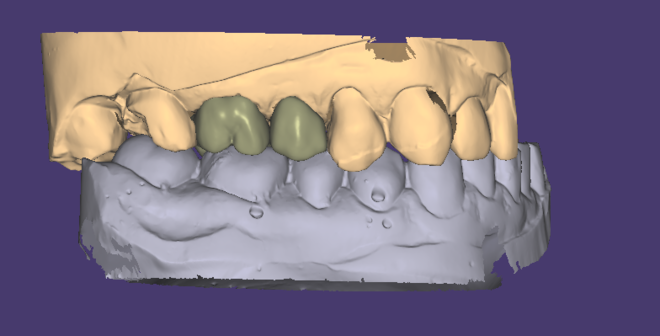 Crown&Bridge design - CadCam Masters