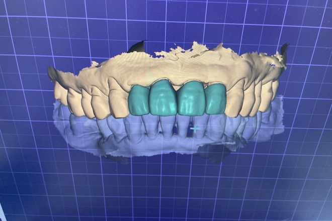 Crown and Bridge design